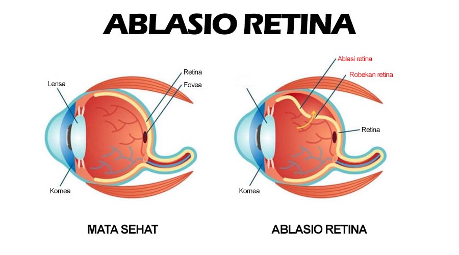 ablasio retina