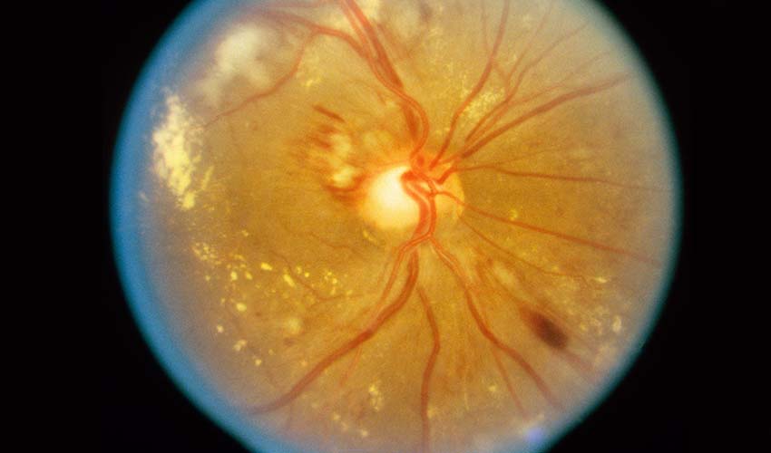 retinopati hipertensi