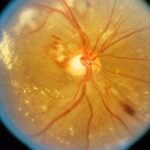 retinopati hipertensi